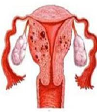 Adenomyosis és endometriosis - mi a különbség? Mi a különbség az endometriózis és az adenomóza között?