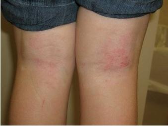 Atópiás dermatitis gyermeknél: kezelés és tünetek