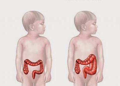 Hirschsprung-kór a gyermek tüneteiben