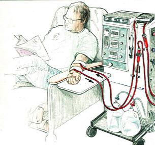 Hemodialízis - mi ez az eljárás?
