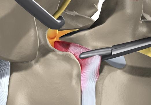 Hogyan kezeli az intervertebralis hernia?