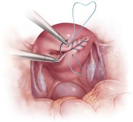 Laparoszkópos myomectomia - mikor és kivel végzik?