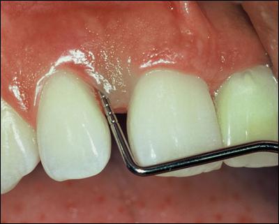  periodontitis kórelőzmény