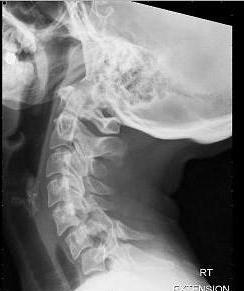 gerincvelő-artériás szindróma nyaki osteochondrosissal